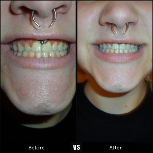 Just naturally whitening my teethâ€¦. | The Crunchy Delinquent